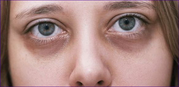 Kako ukloniti tamne krugove ispod očiju (Crni, plavi, ljubičasti)